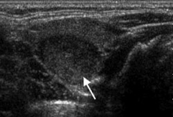 Thyroid ultrasound demonstrating a thyroid nodule