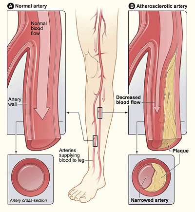  Plaque in unhealthy arteries reduces the flow of blood to the extremities.