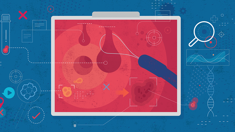 Flat vector illustration with hand drawn textures depicting the concept of colonoscopy with particular emphasis on colon polyp removal.