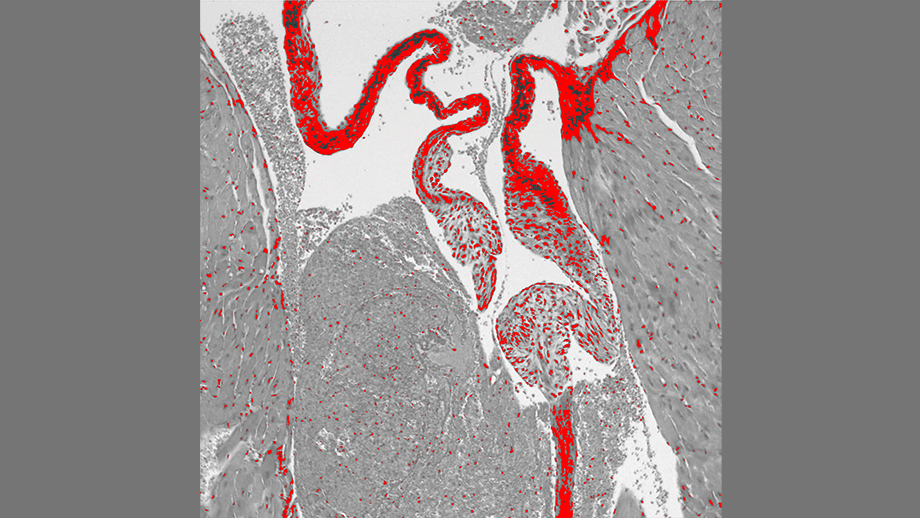This image shows the mitral valve of the heart of a mouse that lacks the serotonin transporter (SERT) gene. The valve was stained with prico-sirius red to show collagen. SERT knockout mice had a thickened mitral valve compared to normal mice.
