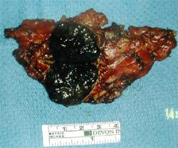 Metastatic melanoma in adrenal gland