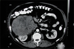 Adrenal cancer on CT