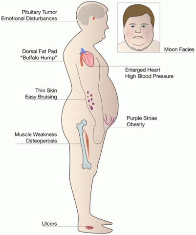 Cushing's Syndrome Physical Signs