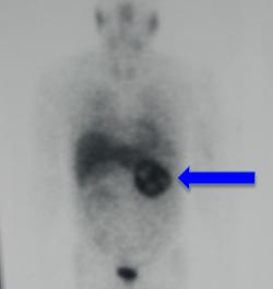 Pheochromocytoma on MIBG scan