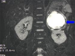 Pheochromocytoma on MRI