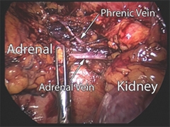 View of the left adrenal gland and surrounding organs through the laparoscopic retroperitoneal approach
