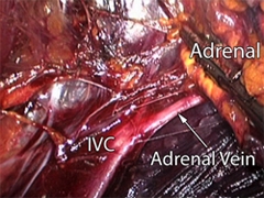 View of the right adrenal gland and surrounding organs through the laparoscopic retroperitoneal approach