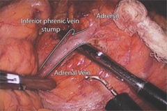 View of the left adrenal gland and left adrenal vein through the laparoscopic transabdominal approach