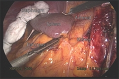View of the organs surrounding the left adrenal gland through the laparoscopic transabdominal approach
