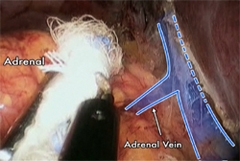 View of the right adrenal gland and right adrenal vein through the laparoscopic transabdominal approach