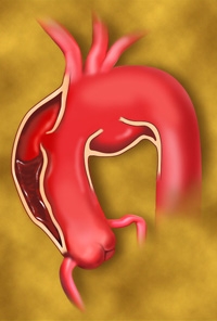 Aortic Dissection