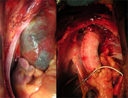 Before and after surgery to correct Type A dissection