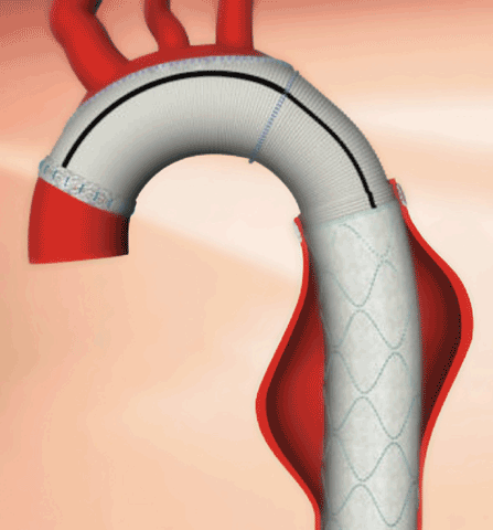 In the elephant trunk procedure, the aortic arch is repaired first. During this first phase, the aorta is prepared so that it can easily accept a thoracic stent graft, which is then placed in the second stage of the procedure.