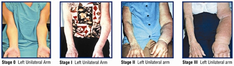 Lymphedema in the left arm of patients at stage 0, stage 1, stage 2 and stage 3. Images courtesy of Dr. Charles McGarvey of CLM Consulting, and Guenter Klose of Klose Training and Consulting, LLC.