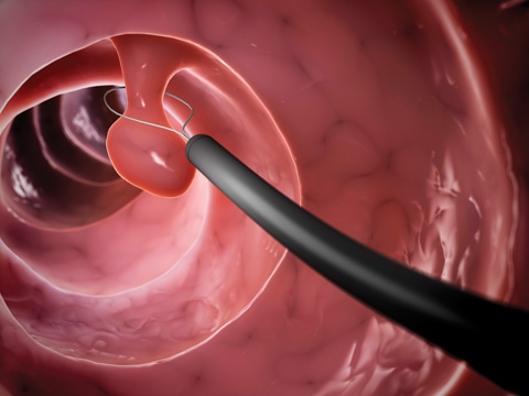 During colonoscopy, your doctor examines the inside of the rectum and entire colon through a flexible, lighted tube. The doctor may remove polyps and collect samples of tissue or cells for closer examination.