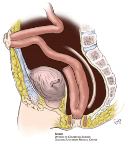 J-pouch procedure. An alternative to traditional ileostomy