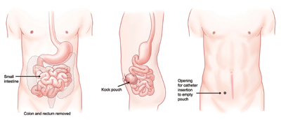 K-pouch surgery entails connection of the end of the small intestine to the skin of the abdomen. Unlike other ileostomies, which drain continuously into an external appliance (bag), the K-pouch includes a special valve that prevents waste from leaking out