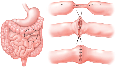 A stricture, or narrowing in a segment of the intestine. The illustrations above show the surgical approach to treat a stricture. We are experienced in performing this procedure using a minimally invasive approach.