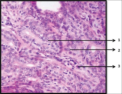 Named Orphan Annie Nuclei because the appearance of these abnormal nuclei resembles the “Eyes Of Orphan Annie” from the daily comic strip by Harold Gray. 