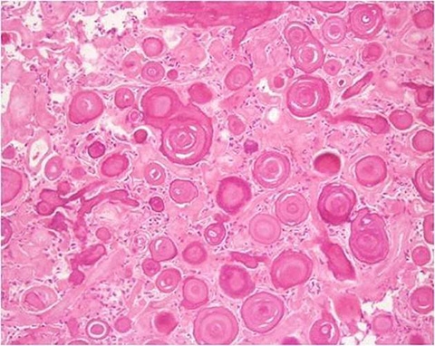 Psammoma Bodies; Image courtesy of A.Prof Frank Gaillard, Radiopedia