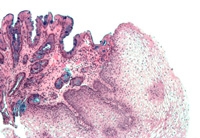 Esophageal epithelium with Barrett's esophagus (left of image) and normal stratified squamous epithelium (right of image). Source: Nephron