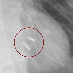 Chest radiograph showing two MitraClips projecting over the heart
