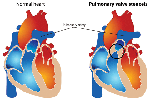 Pulmonary valve stenosis is a heart valve disorder in which outflow of blood from the right ventricle of the heart is obstructed at the level of the pulmonic valve. The most common cause of pulmonary valve stenosis is congenital heart disease.