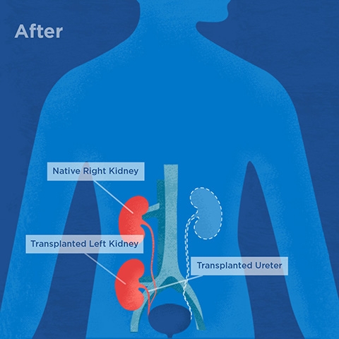 Illustration of after kidney autotransplant procedure