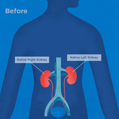 Illustration of before kidney autotransplant procedure