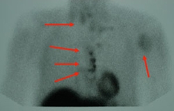 Metastatic parathyroid cancer on sestamibi scan