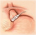 The gastric banding procedure.