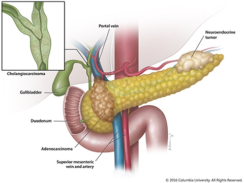 A few of the cancer types that affect the pancreas and gallbladder