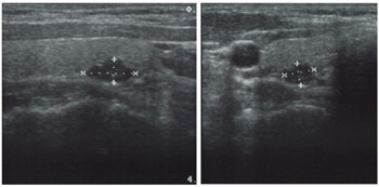 Ultrasound demonstrating a right lower parathyroid adenoma