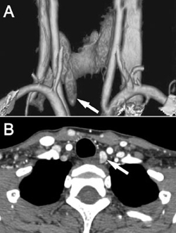 Parathyroid series images localizing a single abnormal left lower parathyroid gland