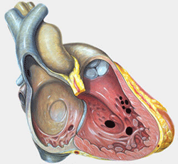 Patients who have Swiss cheese VSDs have multiple holes in the wall that separates the two chambers of the heart. Maverick’s surgery required a hybrid approach between Dr. Petit and Dr. Bacha to find and repair the holes in his heart.