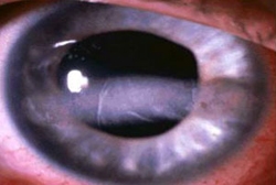 Very high calcium levels causing calcium deposits in the eyes called band keratopathy