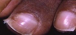 Very high calcium level causing calcium deposits in the fingernails