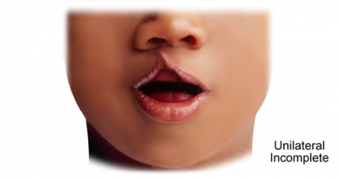 Unilateral Incomplete Cleft Lip