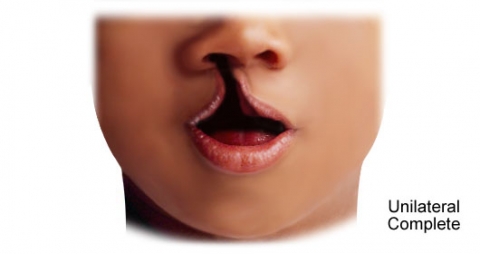 Unilateral Complete Cleft Lip