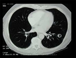 The above image shows a lung nodule in a screening CT scan requested by the patient, a 69-year-old former smoker.