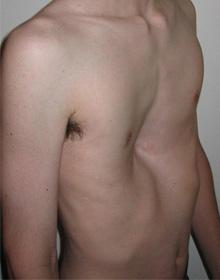 Pectus excavatum, the most common chest wall abnormality, may be caused by excessive growth of the cartilage that connects the ribs to the breastbone.