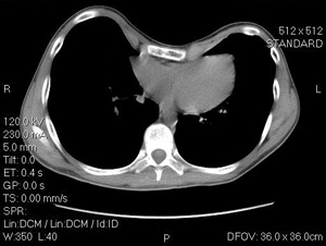 A CT scan of a 14 year old male with severe pectus excavatum