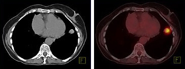 The CT image (left) shows a mass in the left lung. The combined PET/CT image (right) reveals the metabolic activity of that mass, as well as its precise location in the lung. Images courtesy of Siemens.