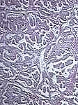 Fig 2. Papillary cancer (low resolution). Notice the frond-like projections.