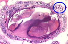 Fig 3. Psammoma body within a papillary cancer. Optically clear nuclei are circled in blue.