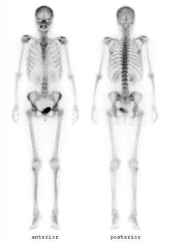 RAI Scan demonstrating thyroid cancer recurrence in the bones