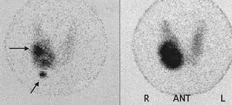 RAI Scan demonstrating multiple 'hot' or toxic nodules