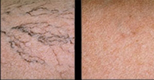 Before sclerotherapy (left) and After sclerotherapy (right)