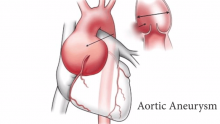 Video Thumbnail: Hybrid Aortic Arch Surgery 
