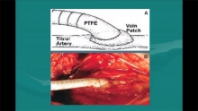 Video Thumbnail: Surgical Approaches for Peripheral Arterial Disease (PAD)